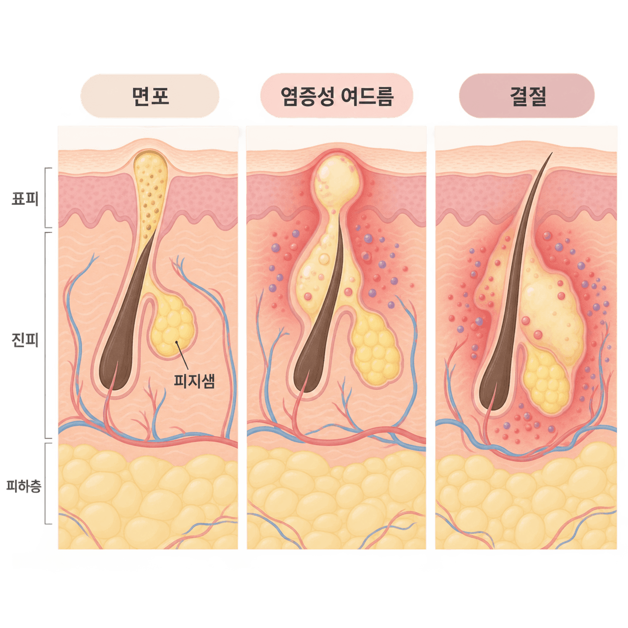 면포·염증성 여드름·결절이 피부 속 어느 깊이에 자리 잡는지 나눠 본 그림