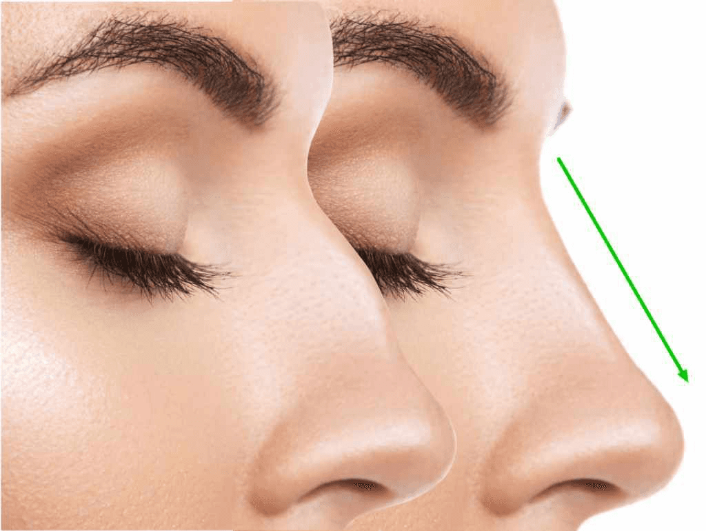 Expertos en Rinoplastia. Heaven Clinics