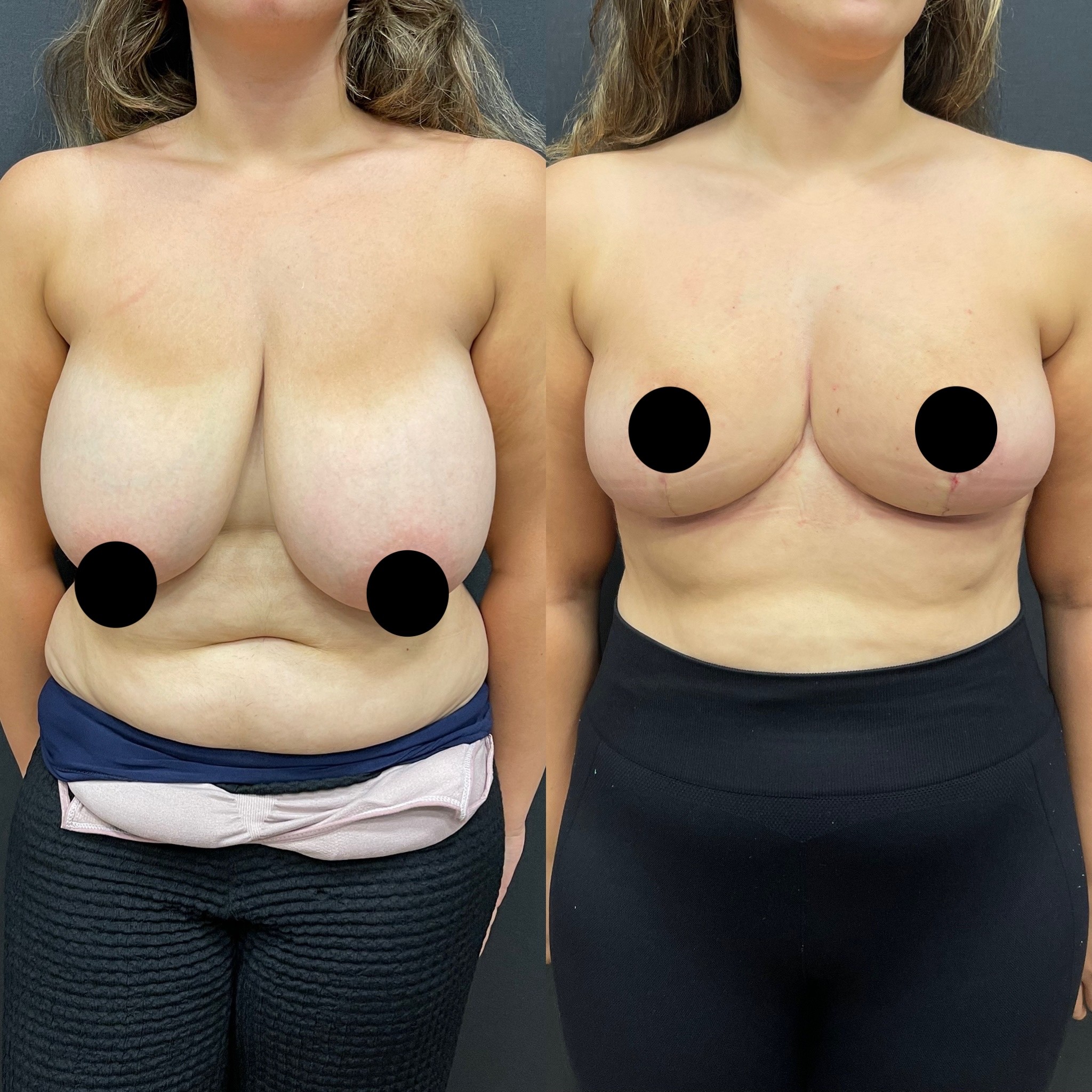 breast lift with internal bra technique before after