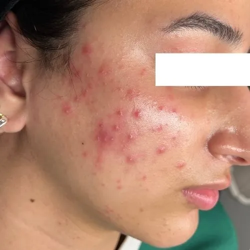 Before exosome PDRN therapy at The Vancouver Aesthetician — active acne, visible inflammation, and compromised skin barrier