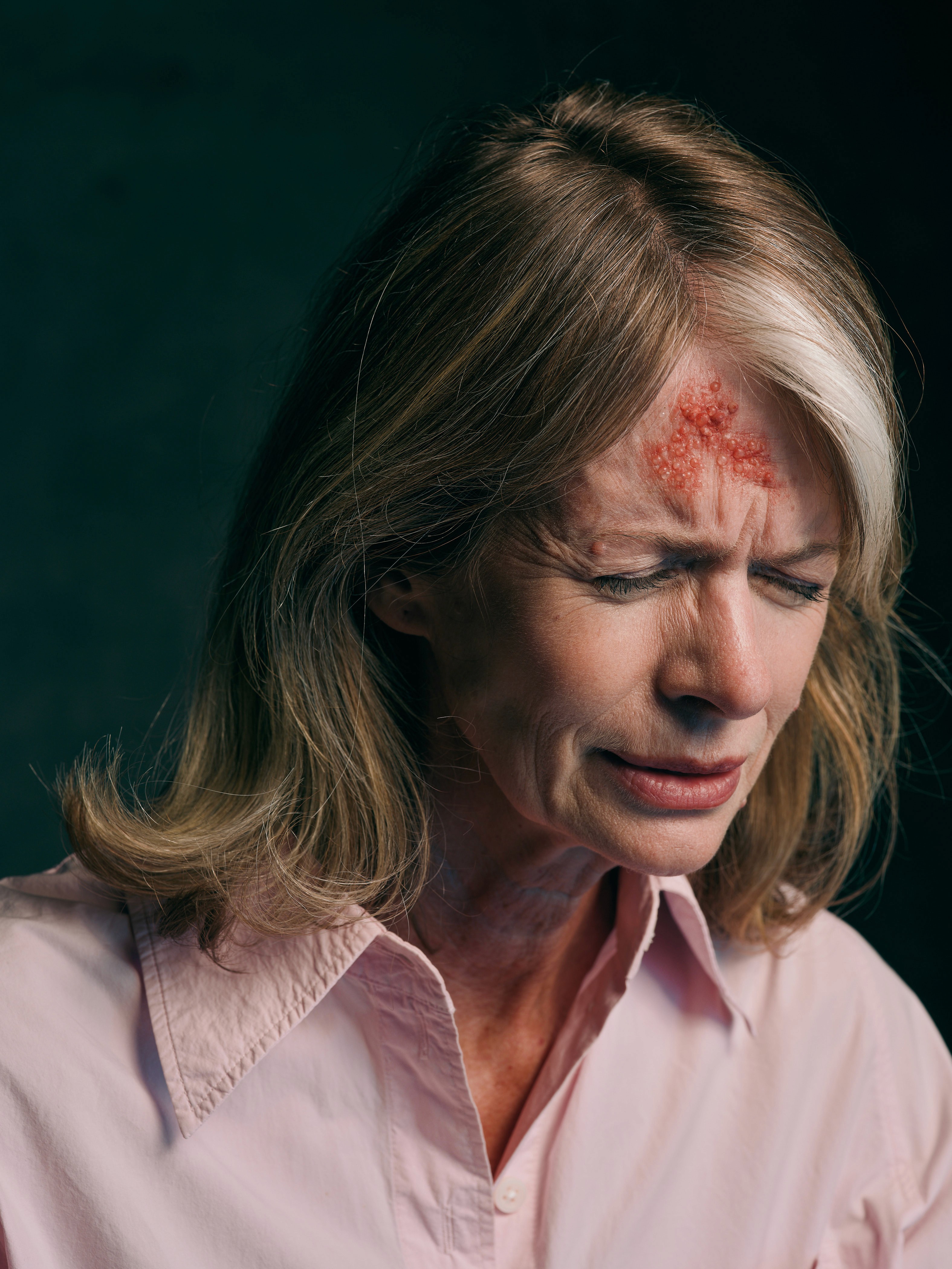 Shingles_woman in pain