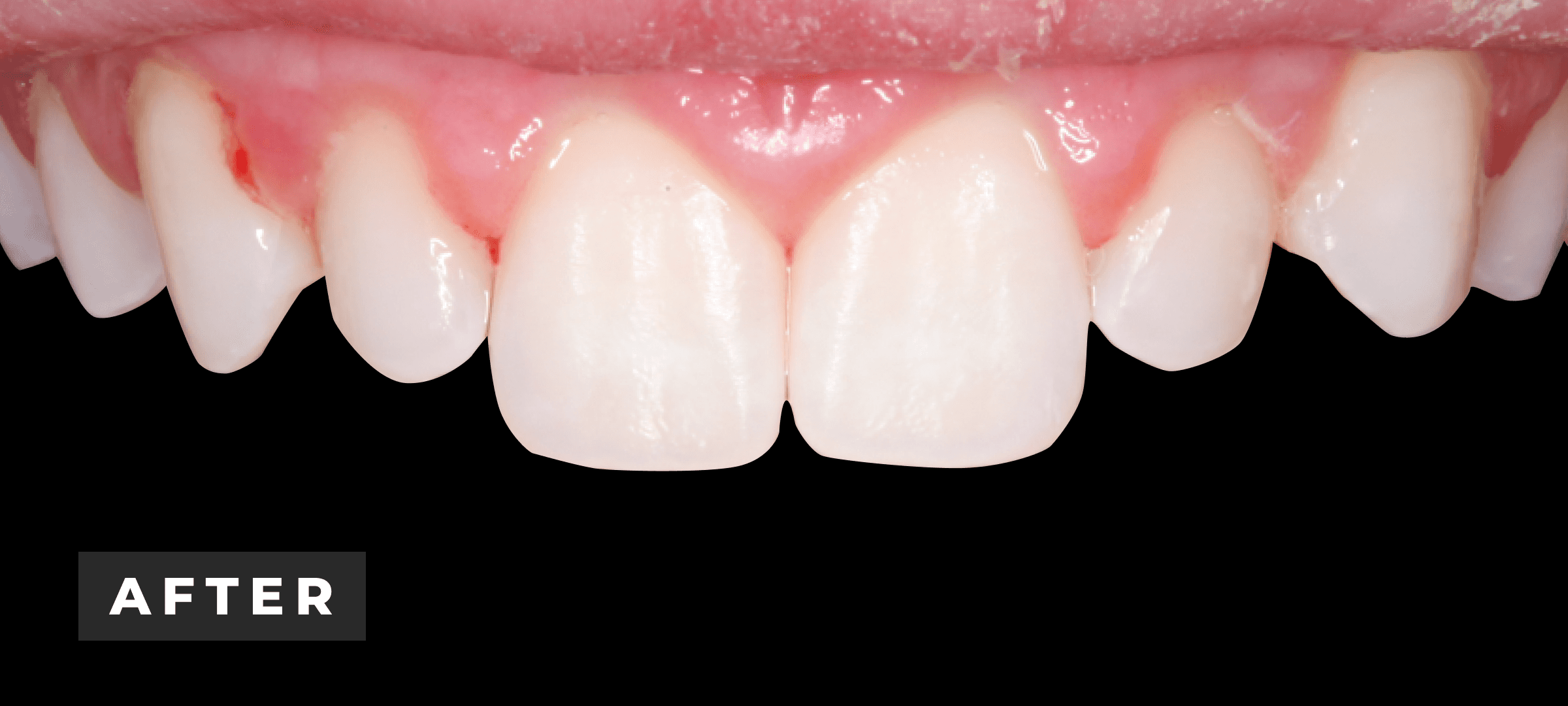 After image of zoom whitening & resin infiltration