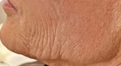 Severe facial skin laxity and sagging on jawline.