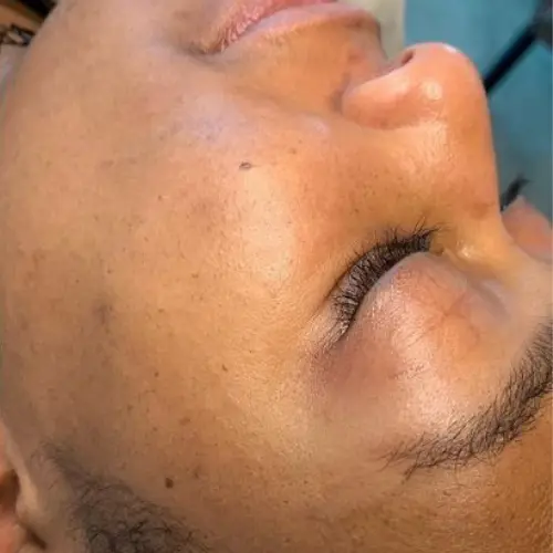 After dermaplaning at The Vancouver Aesthetician — peach fuzz completely removed and skin instantly brighter and smoother