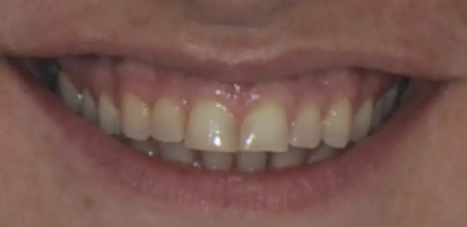 Before ortho treatment