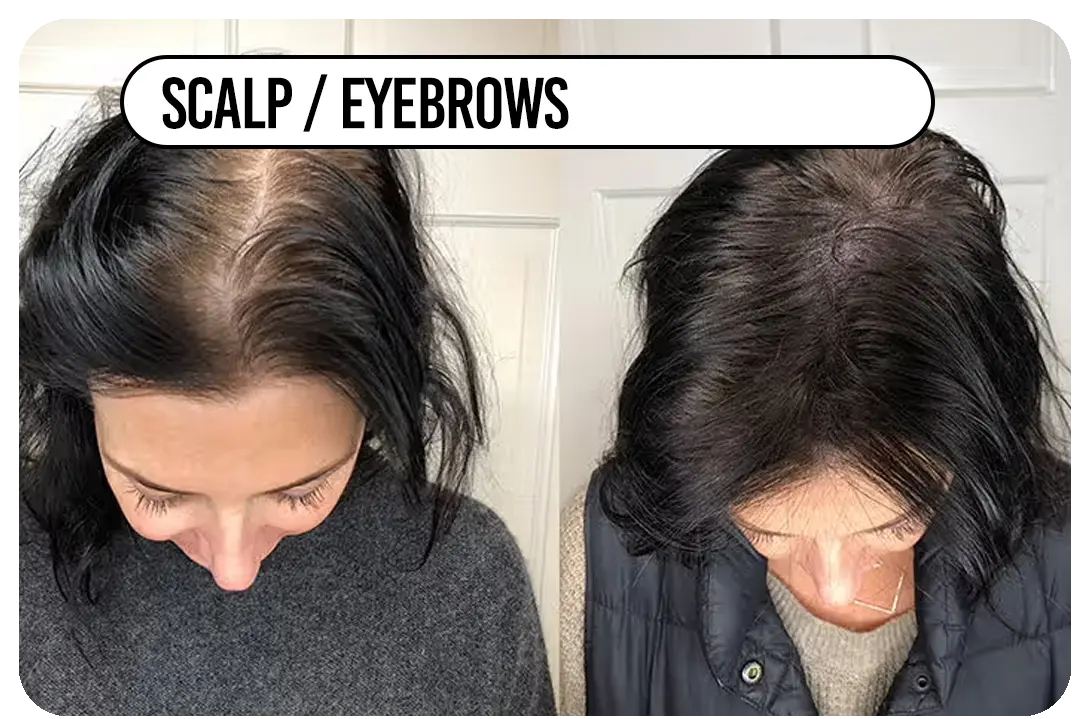 Scalp / eyebrows / creases