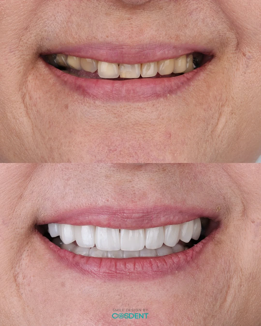 Two close-up photographs comparing tooth colour and shape in a man's smile.