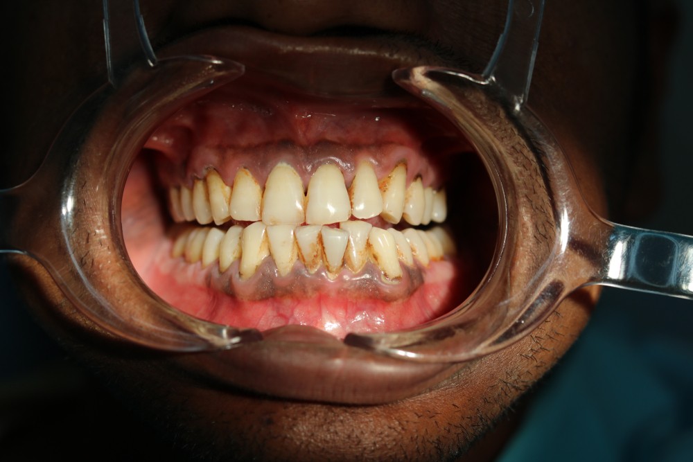 Advanced gum disease causing tartar build-up, gum recession, and inflammation 
