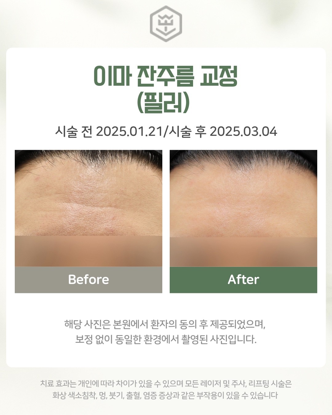 이마 잔주름 교정(필러)