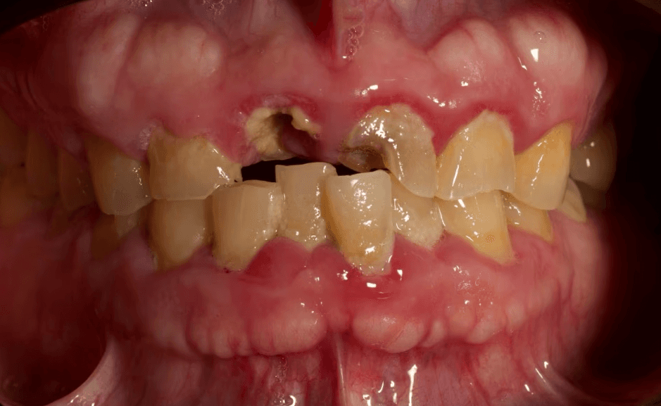Before treatment: worn and fractured anterior teeth