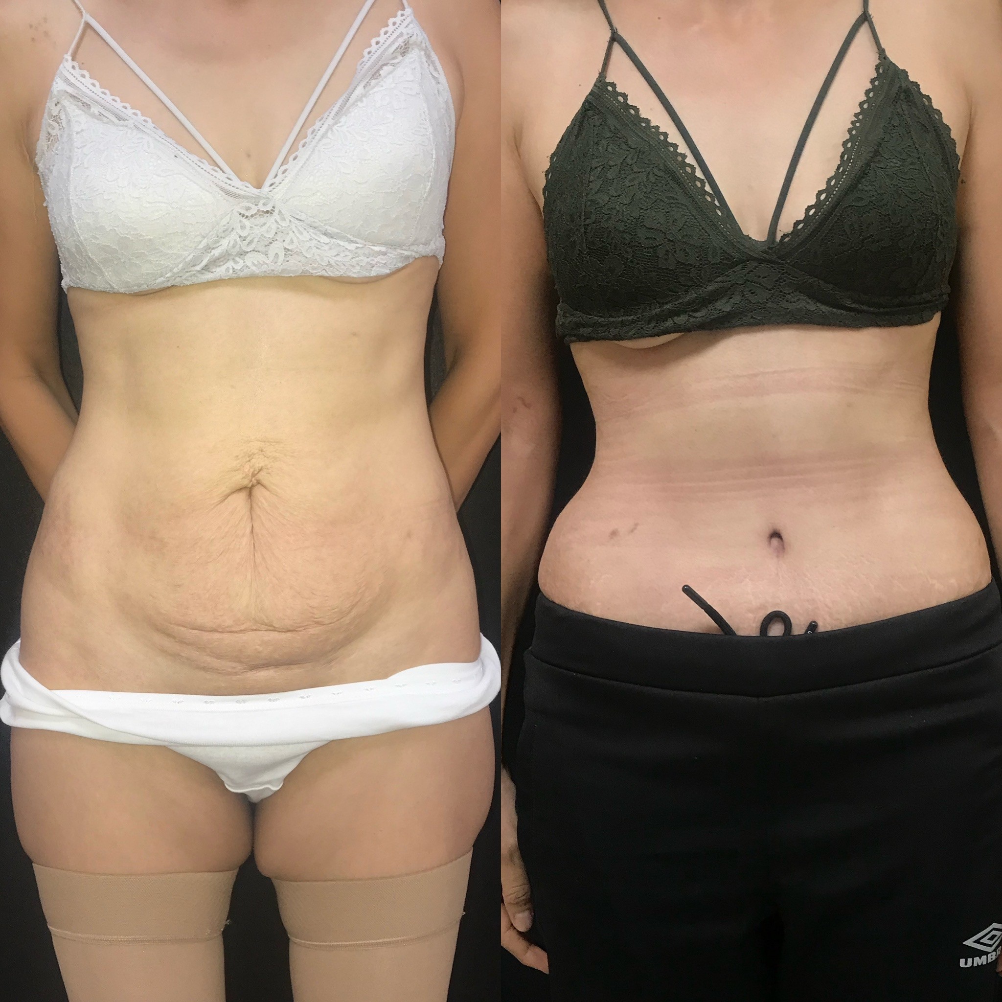 tummy tuck result before after 1 month post-op front view