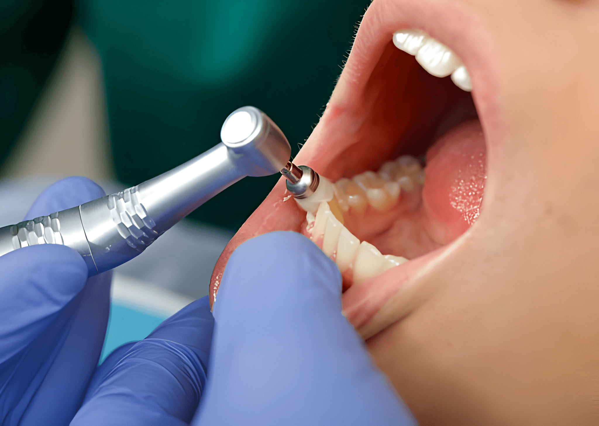 dental polish