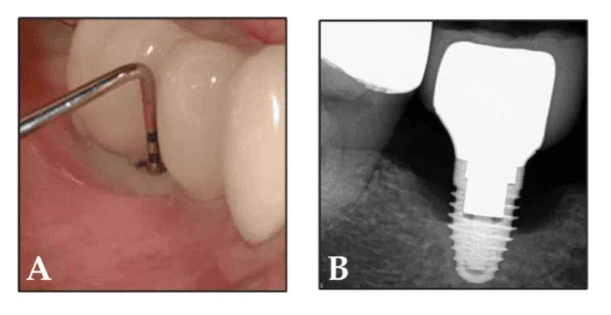 Peri-Implantitis: Risk Factors, Diagnosis and Treatment | Bloor-Yorkville Periodontics