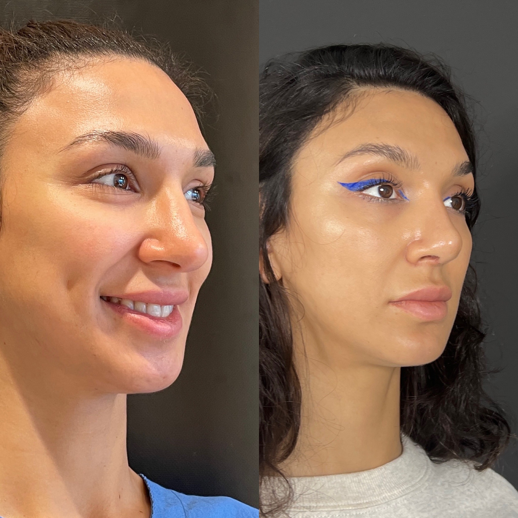 3 weeks post-surgery before after of rhinoplasty oblique view