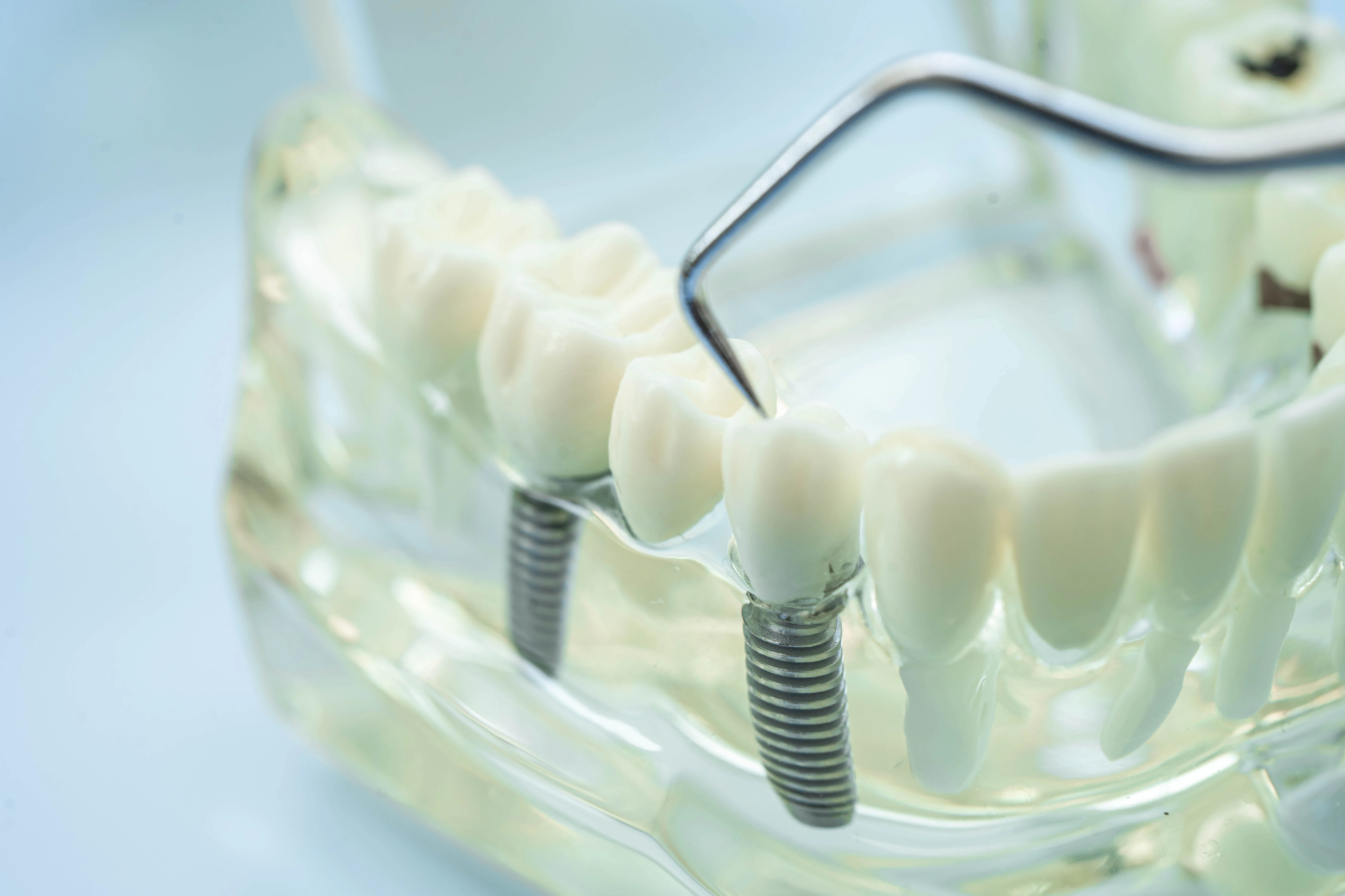 Image of teeth with dental implants