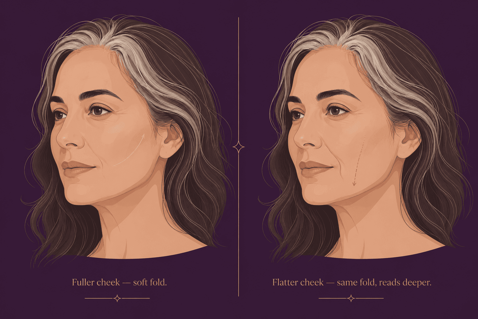 An illustration showing how a flatter cheek makes the same nasolabial fold appear deeper.