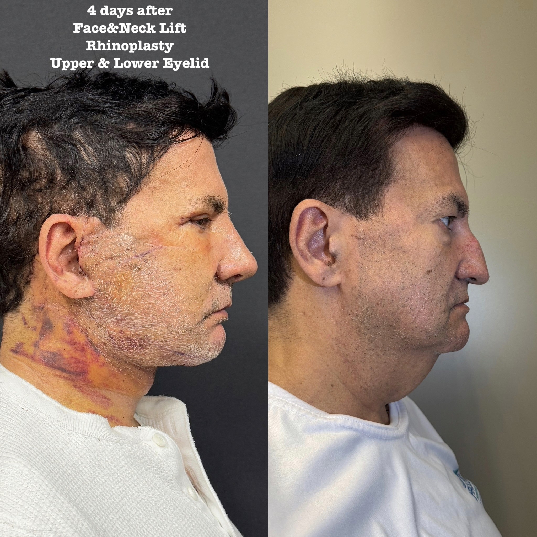 male face neck lift result turkey neck before after photo