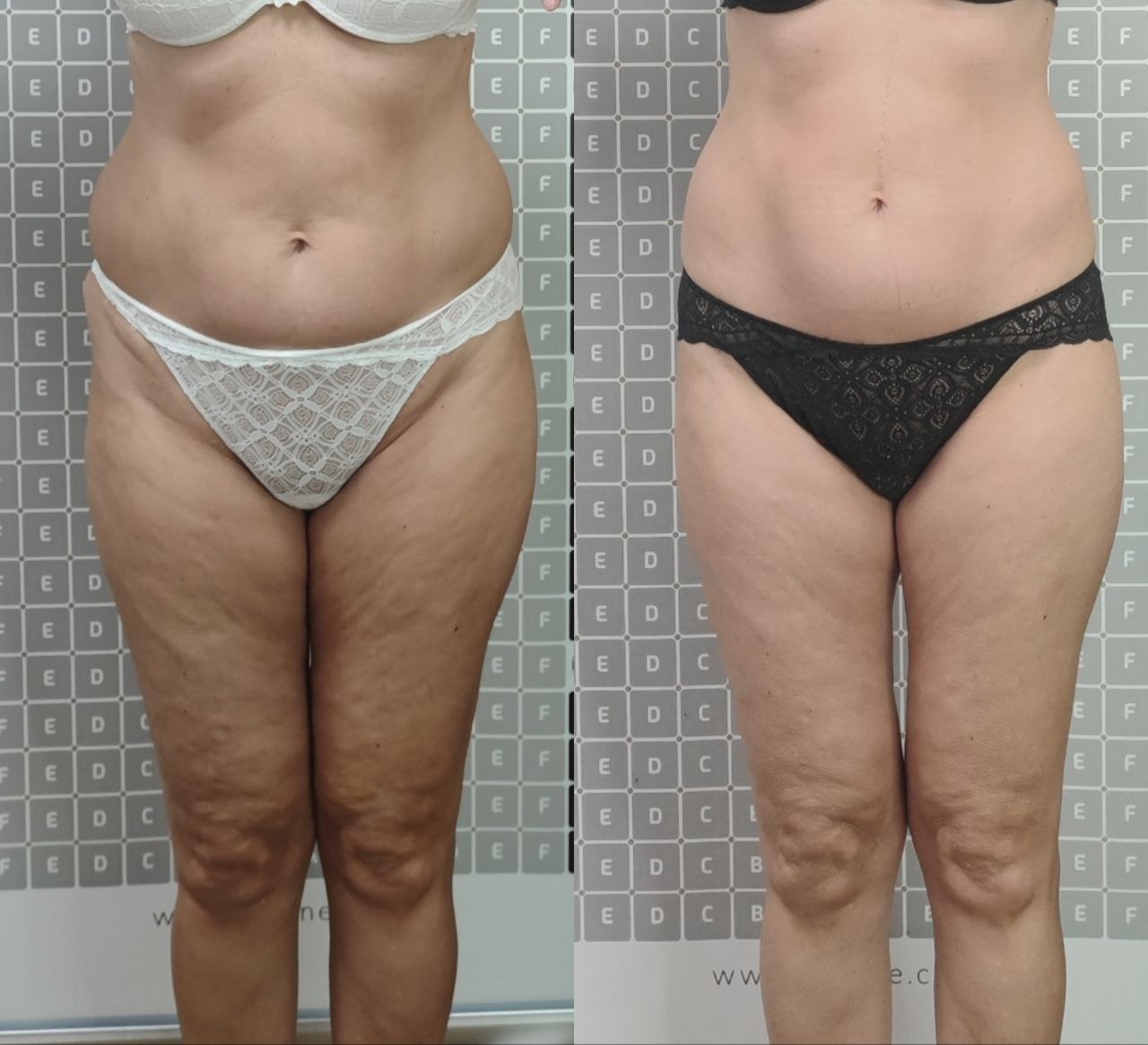 Photos of the results before and after laser body rejuvenation