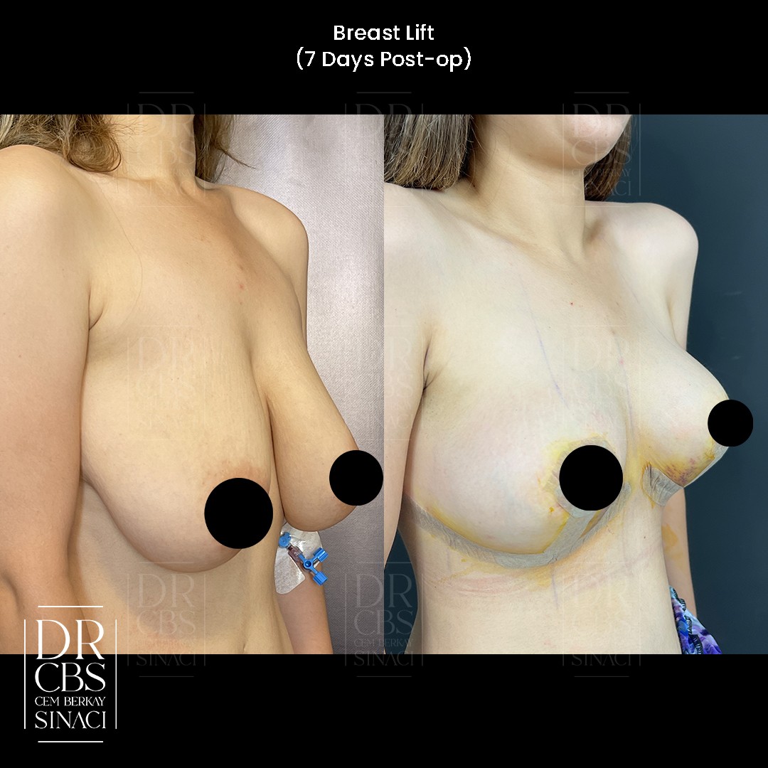 breast lift before after 7 days oblique view