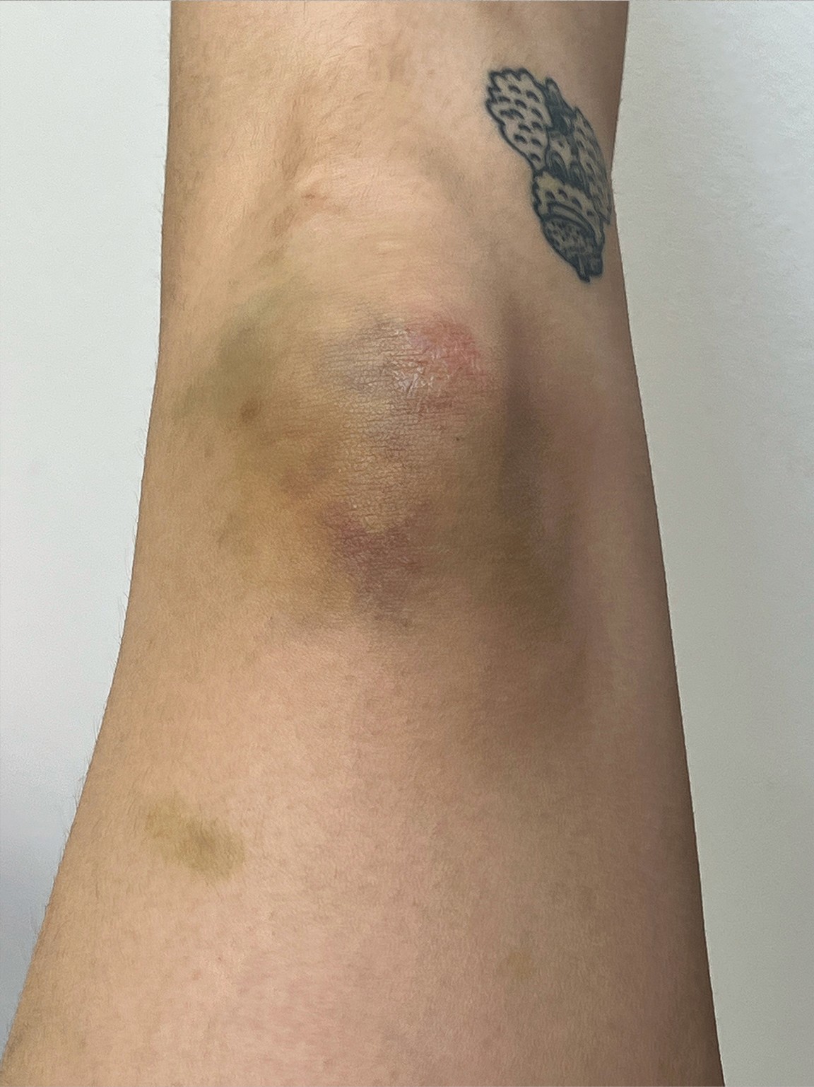 "Bruise on a knee with a tattoo underneath"