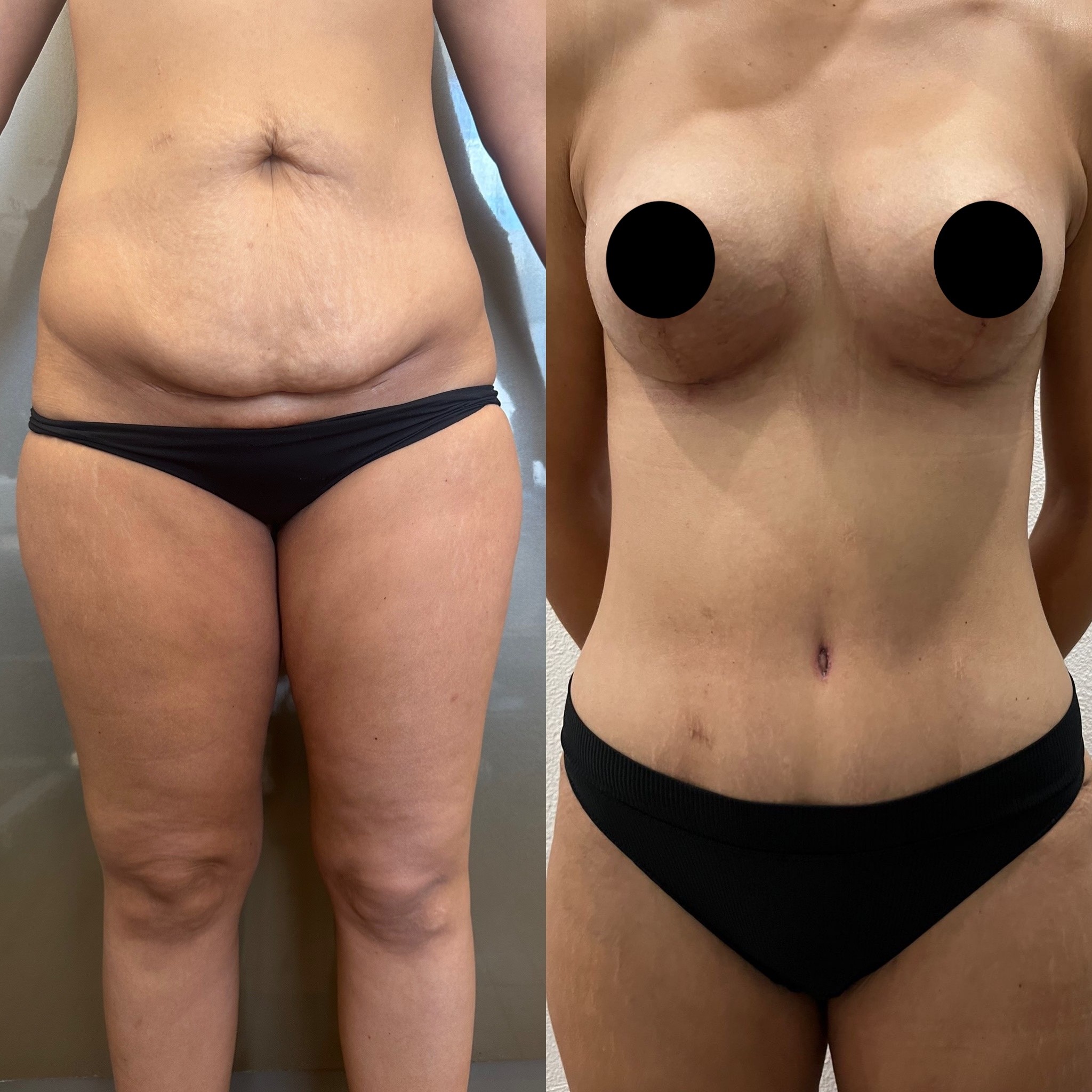 breast lift with implants and tummy tuck (mommy makeover) before after front view