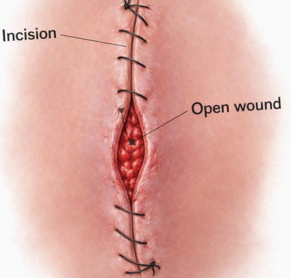 Dehisced Wounds