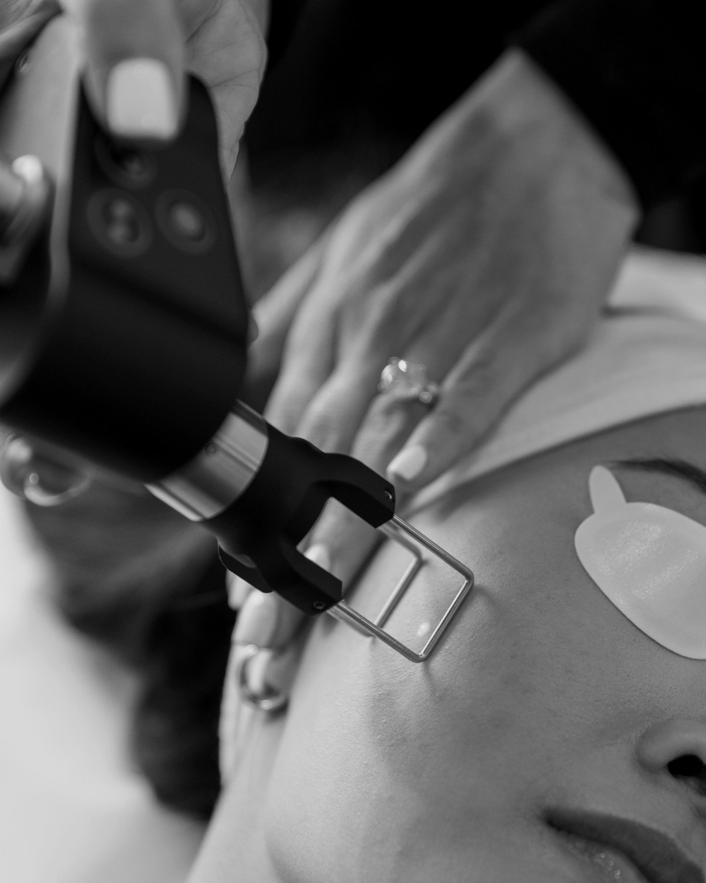A laser handpiece held to a patient's cheek, eyes shielded