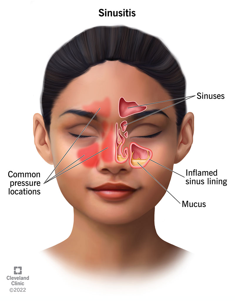 sinus pain