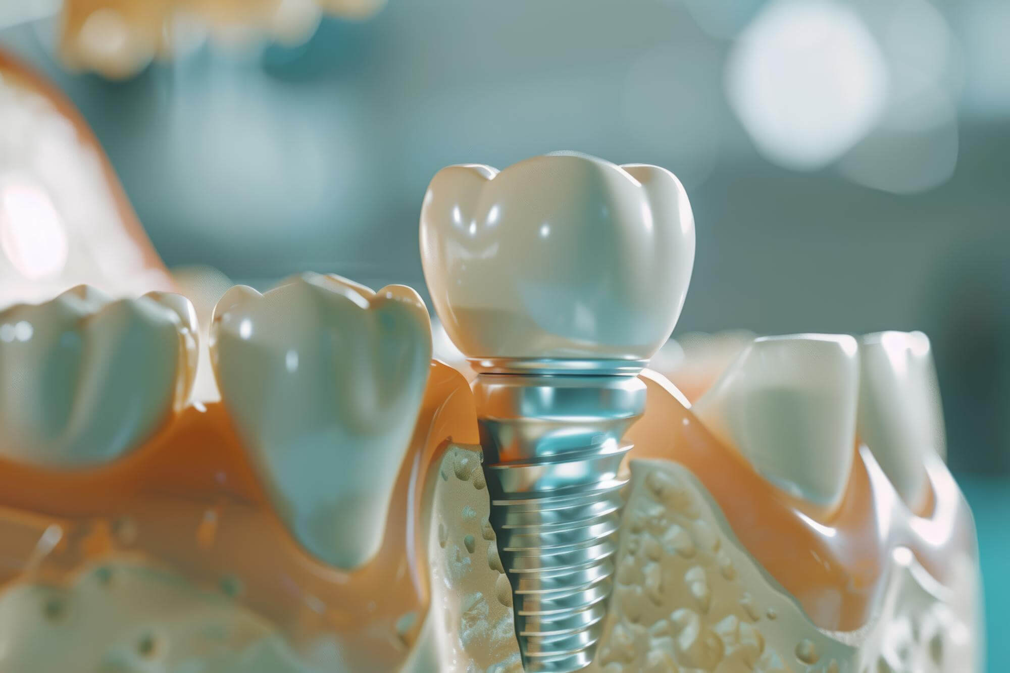 Dental implants, Piara Waters