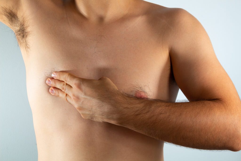 Fat cavitation for male breast