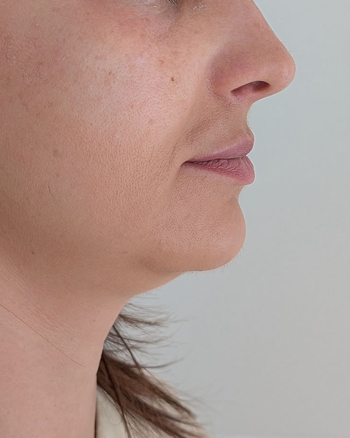 Výrazné nosovo-ústne a marionetové vrásky pred celotvárovým liftingom