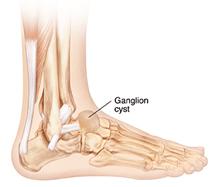 illustration of Lower Extremity Ganglion Cysts