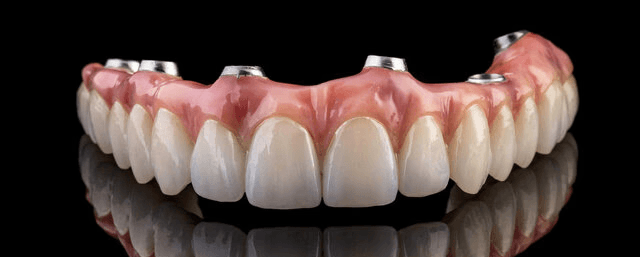 all-on-4 dental implants