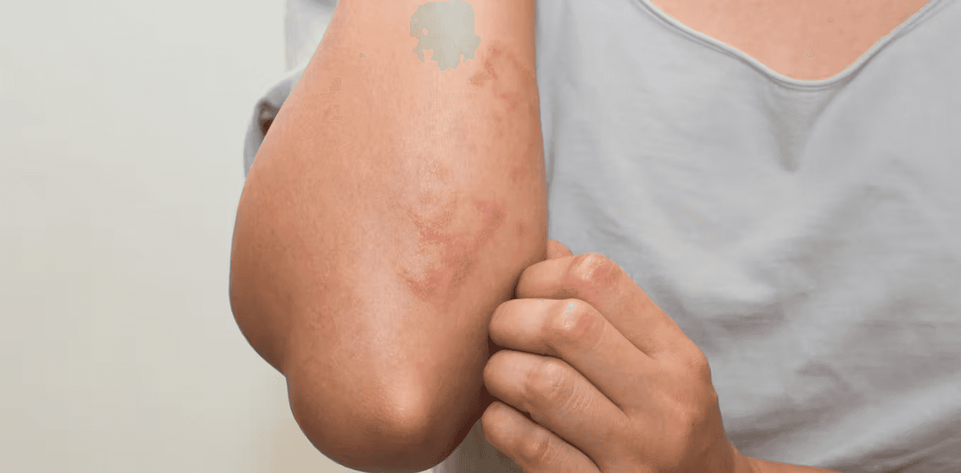 How to Reduce Tirzepatide Rashes and Skin Irritation Safely - MeAgain ⚡ ...
