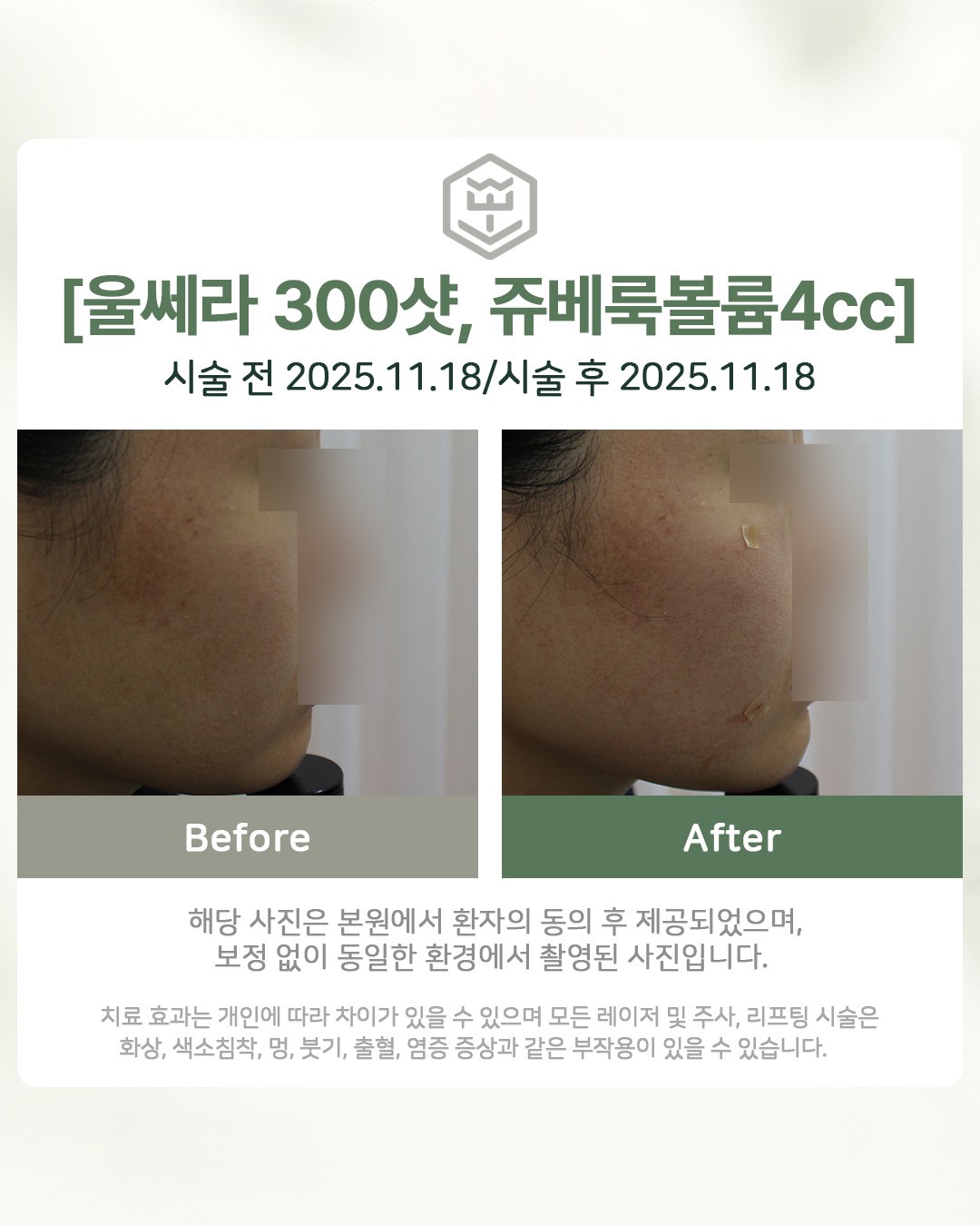 울쎄라 300샷 + 쥬베룩볼륨 4cc