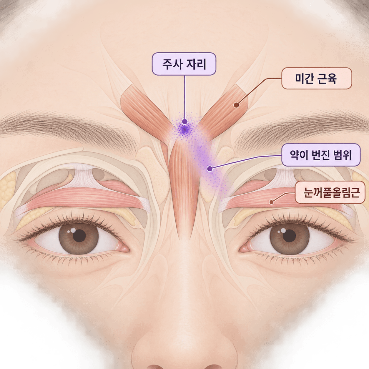 미간에 넣은 약이 눈꺼풀 근육까지 번지면 처짐이 생겨요
