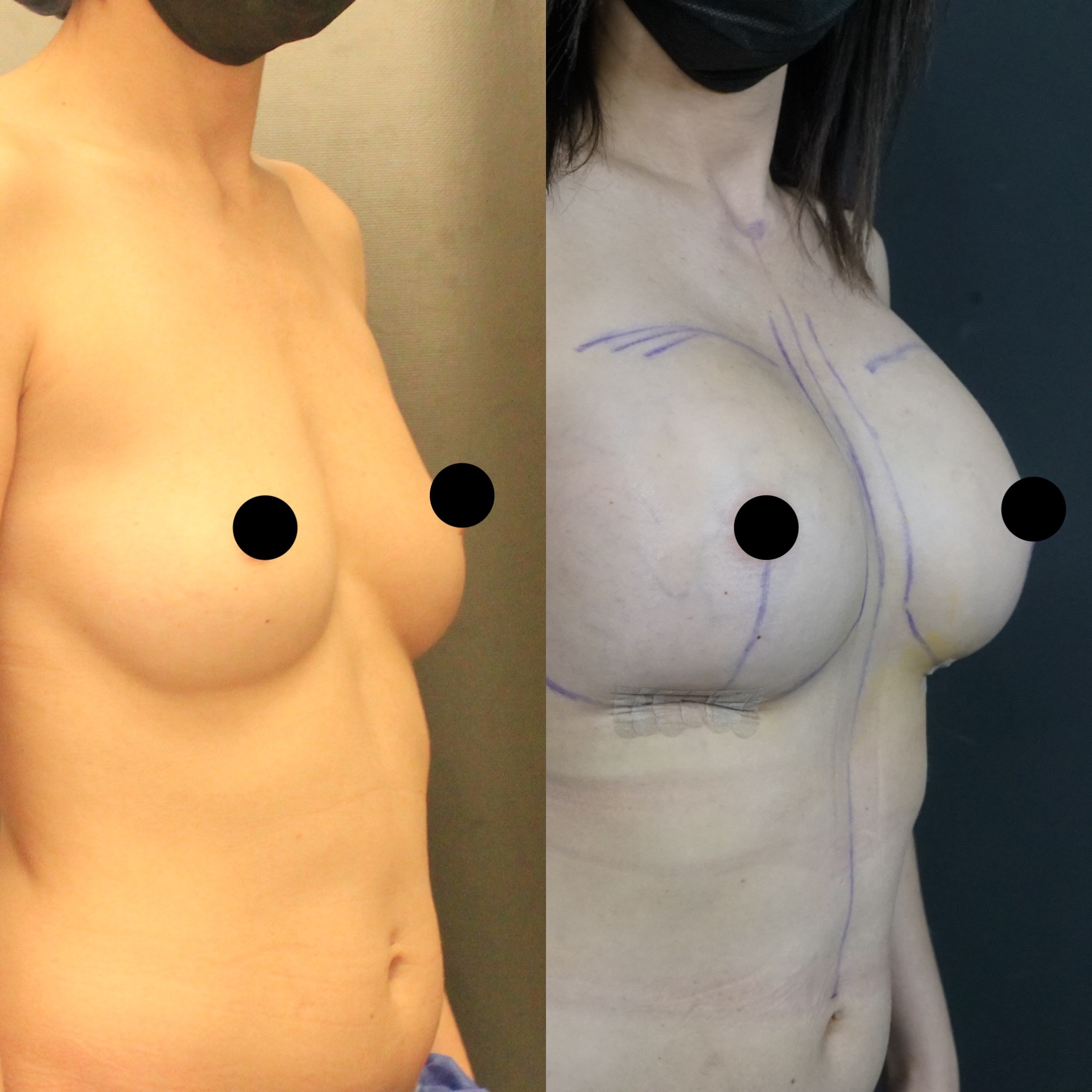 breast implant result 3 days right oblique view