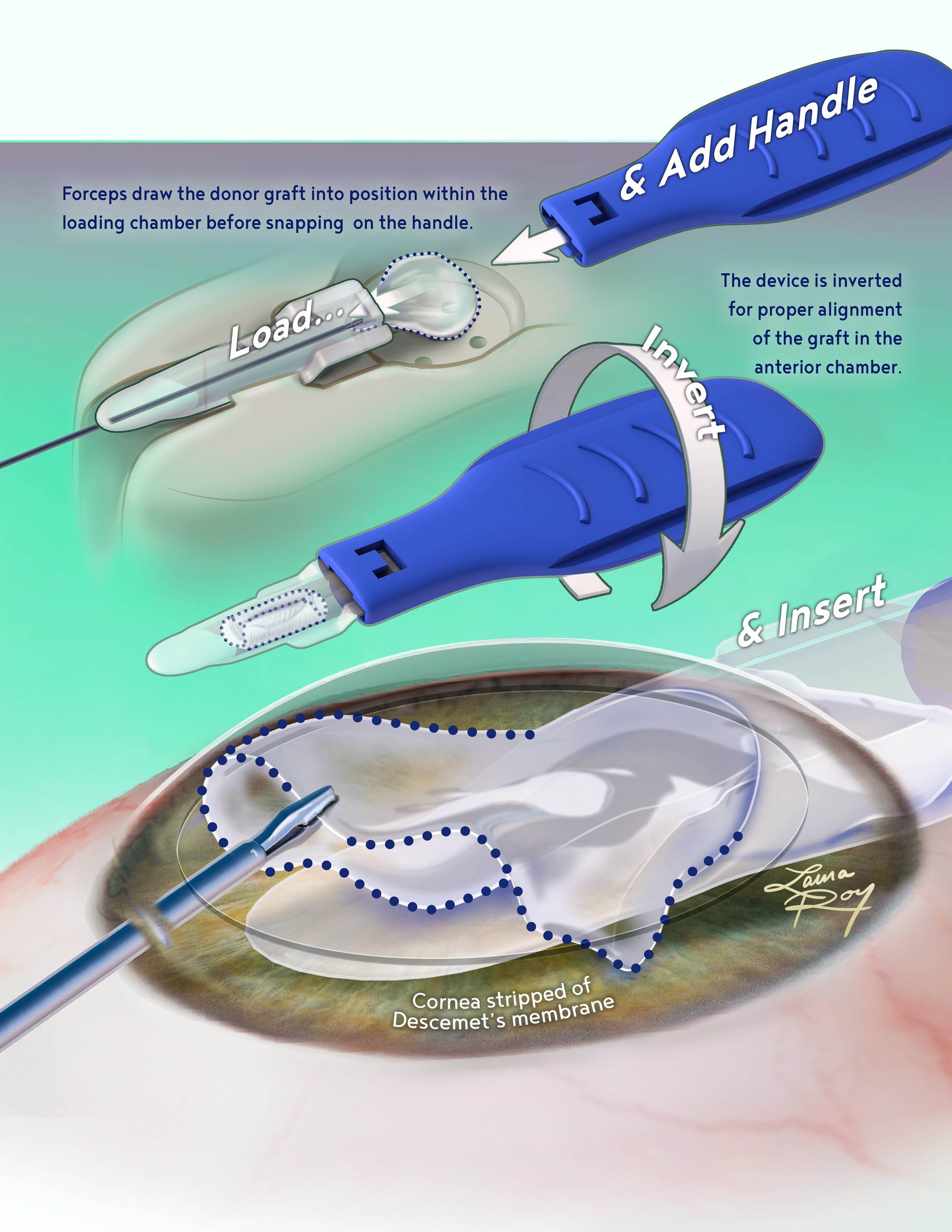 Corneal Graft Deployment Device Poster