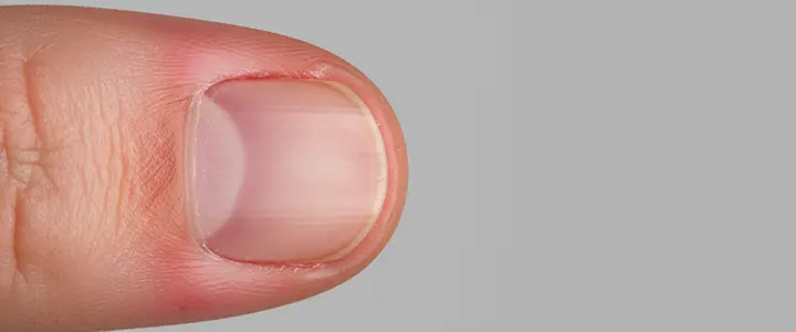 Red/swollen skin around nail