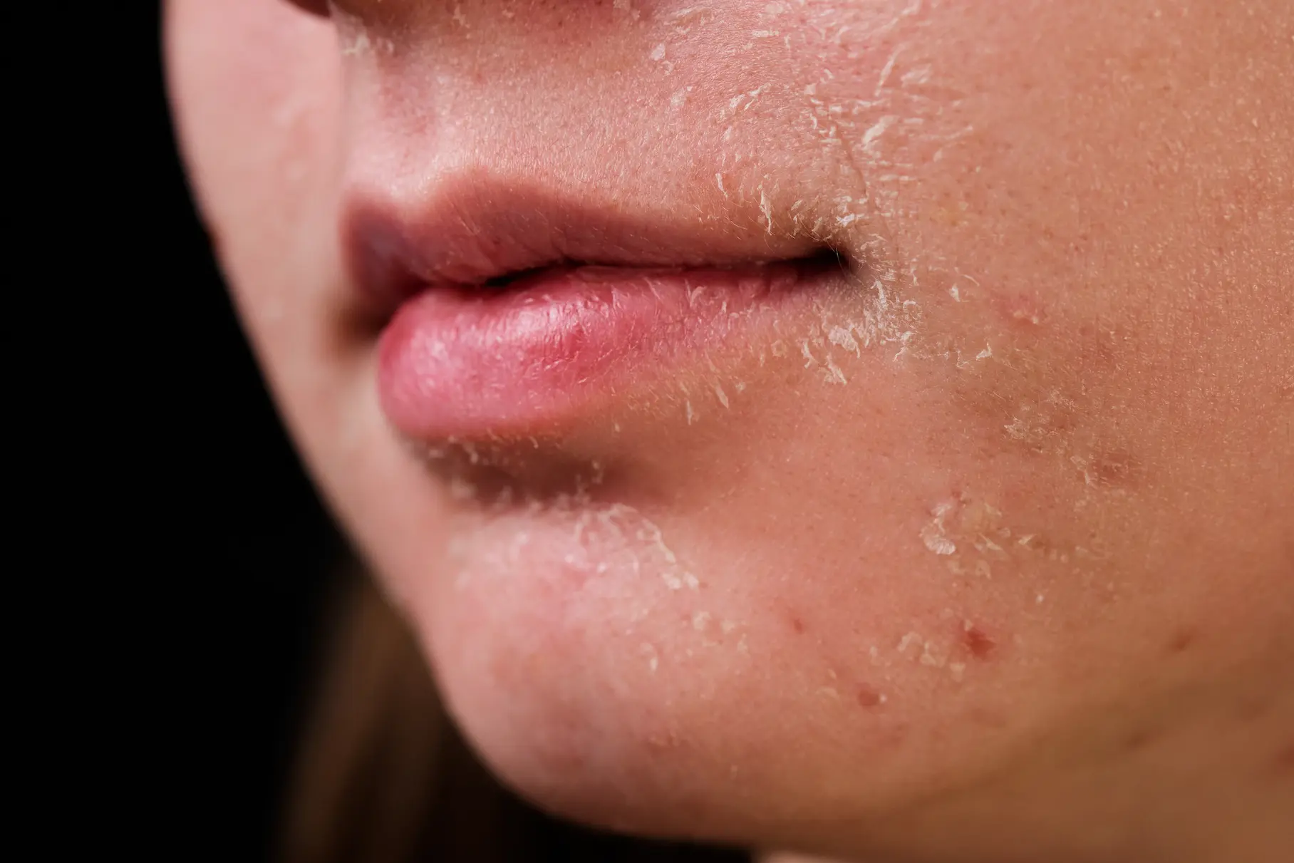 dull and dry skin