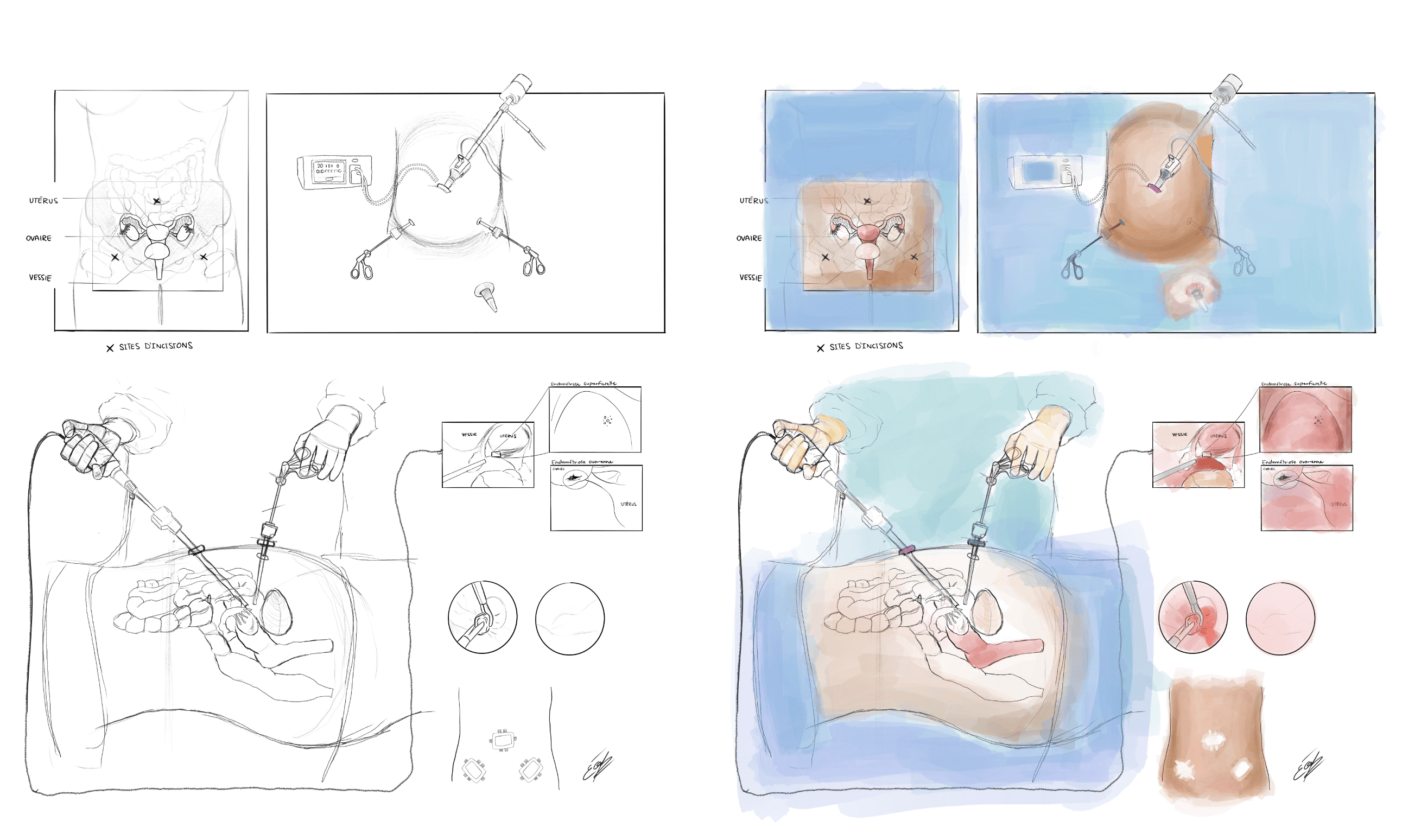 Brouillon de la laparoscopie de l'endométriose en six étapes. Test de couleurs palettes et aquarelle.