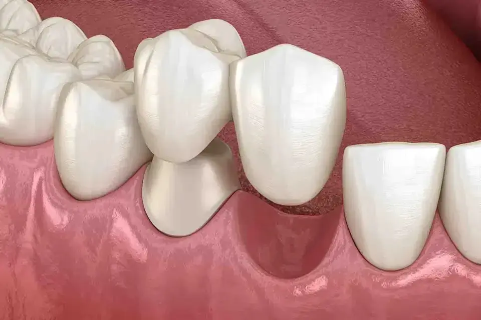 dental bridge in smyrna