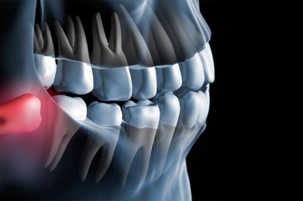 Extração de siso - Dr Bruno Gomes Bucomaxilo