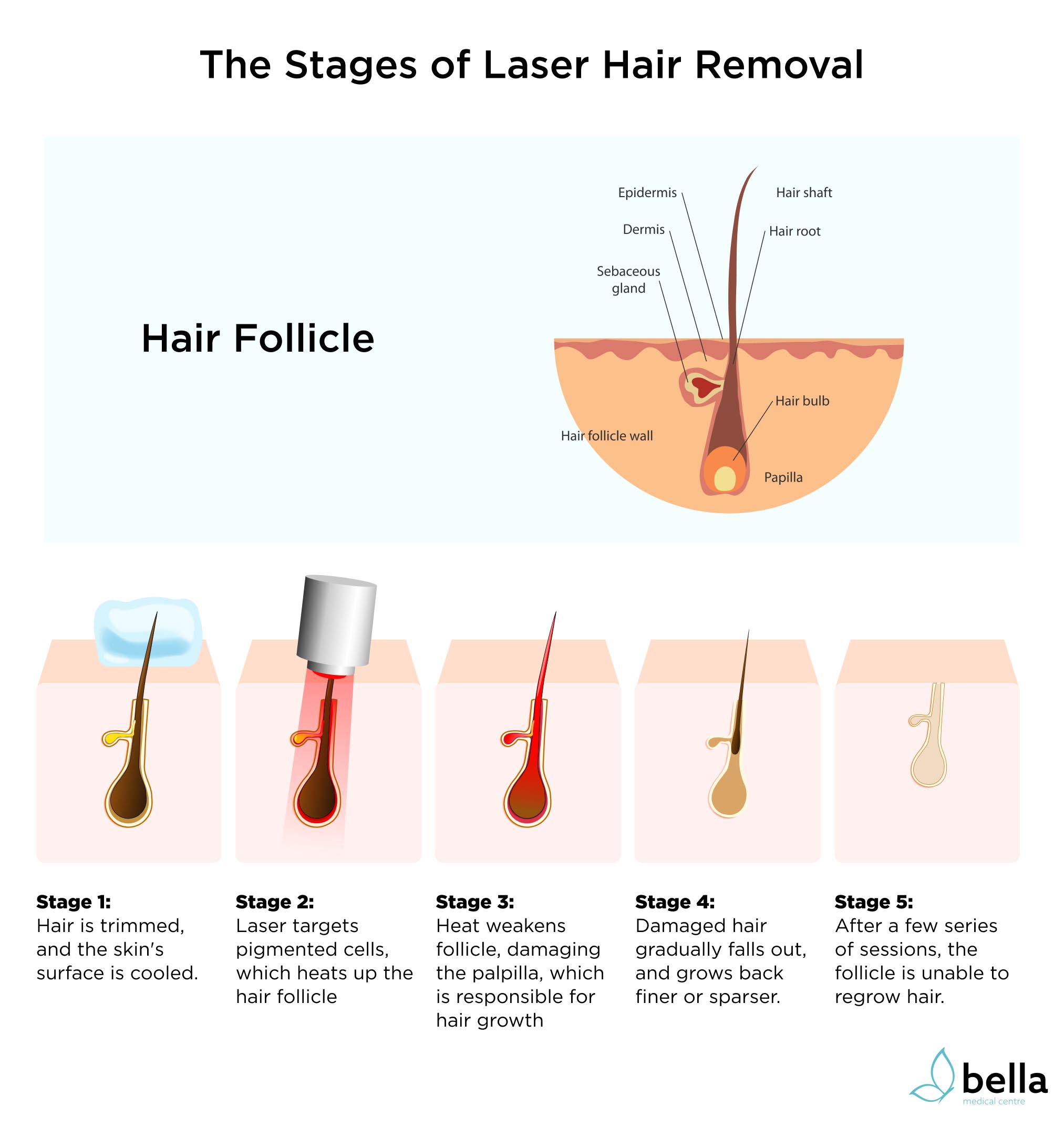 What to expect from each stage of the laser hair removal procedure