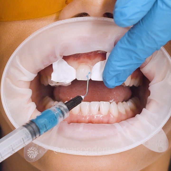 Composite Bonding in Hurghada - Sun Clinics