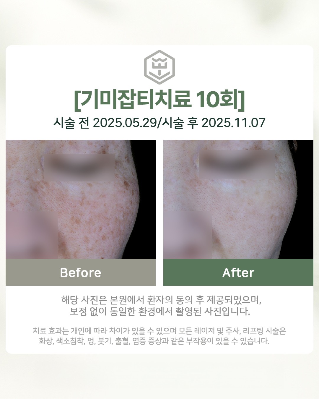 기미잡티치료 10회