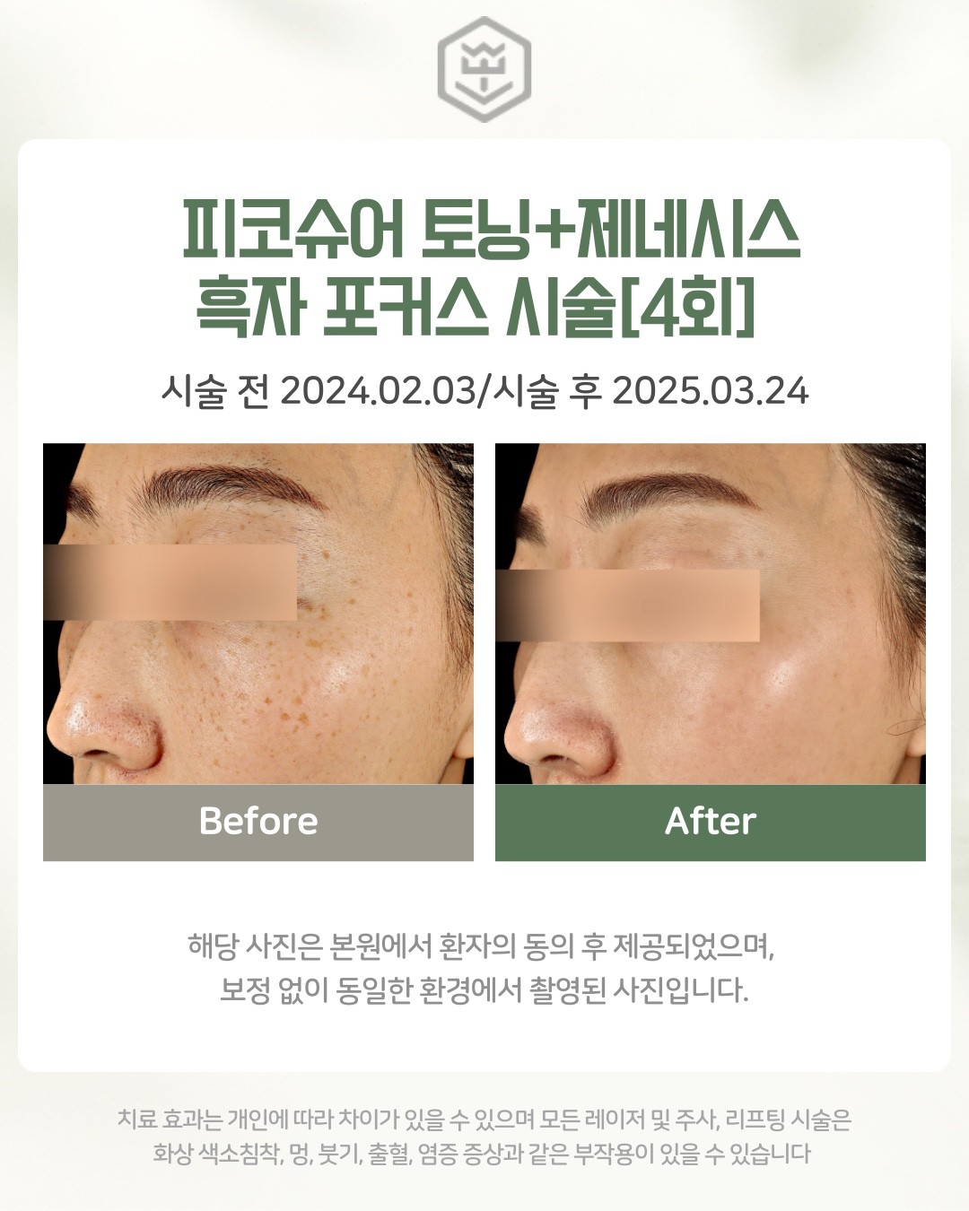 피코슈어+제네시스+흑자포커스 4회