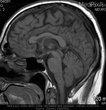 MRI image of a brain
