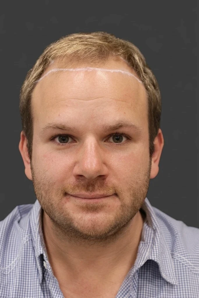 Lichtes Haar im Stirnbereich vor der ästhetischen Haartransplantation