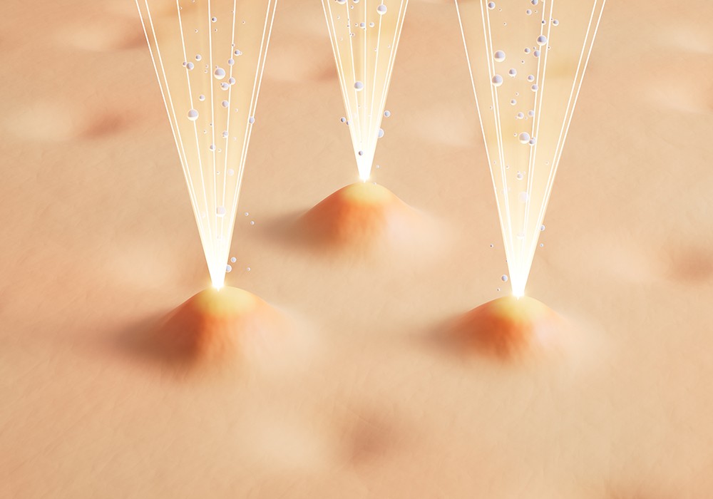 3D illustration of laser targeting skin pores